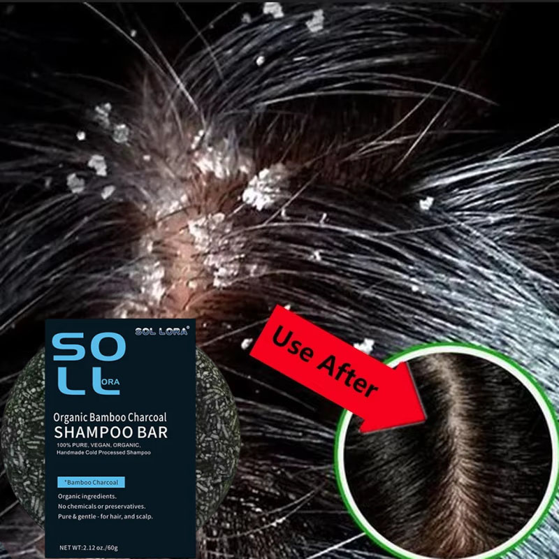 Hair Care Dandruff - Fast Anti Dandruff Hair Treatment Soap
