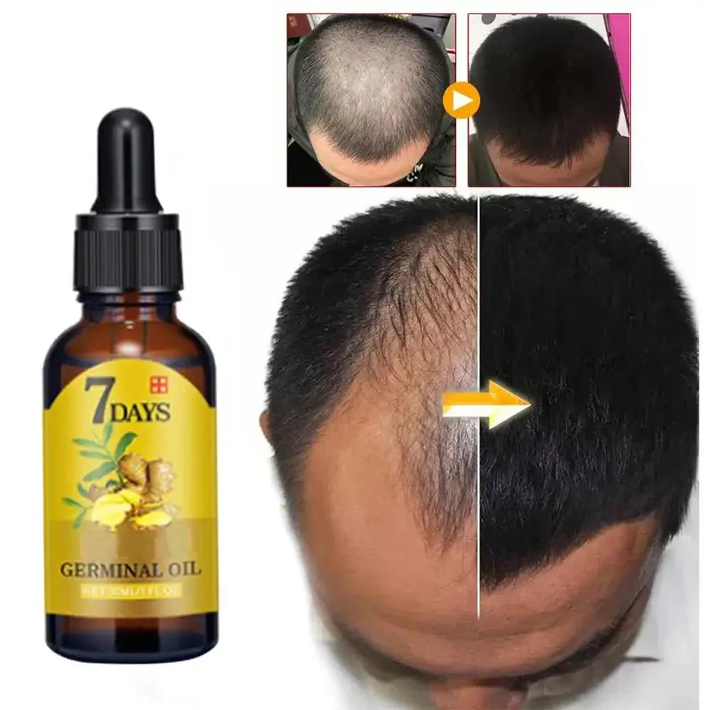 Hair Growth Ginger Fast Growin - đánh giá và giá Hair Care Essence Oil Spray