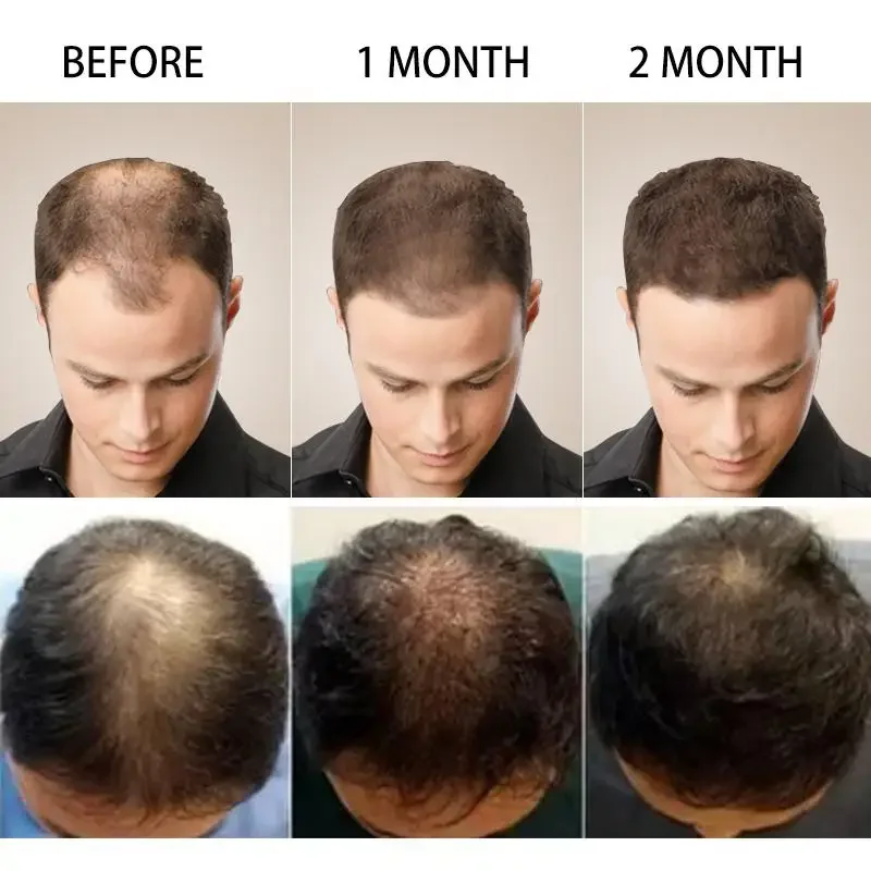 Hair Growth Ginger Fast Growin - đánh giá và giá Hair Care Essence Oil Spray